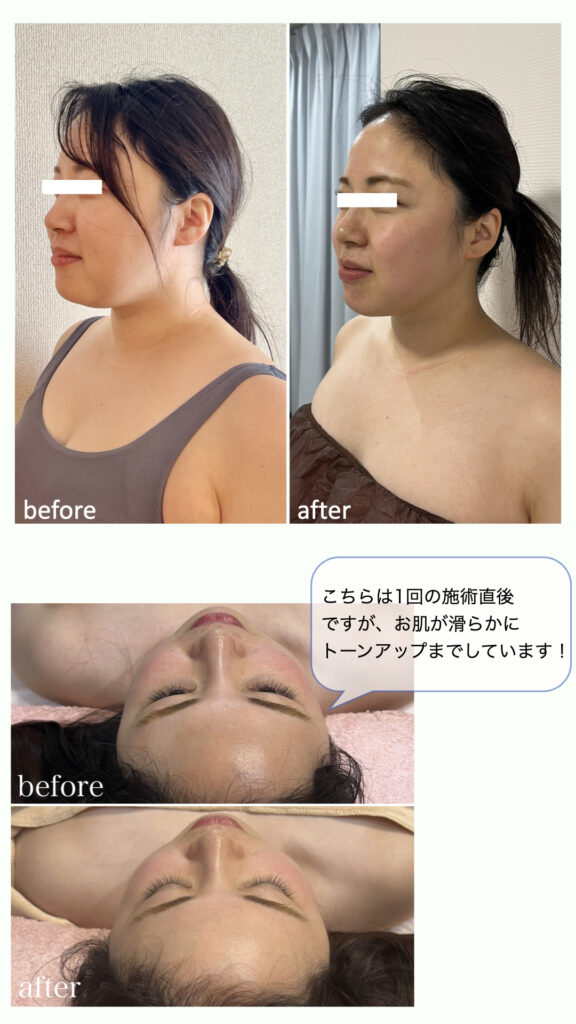 こちらは1回の施術直後ですが、お肌が滑らかにトーンアップまでしています！