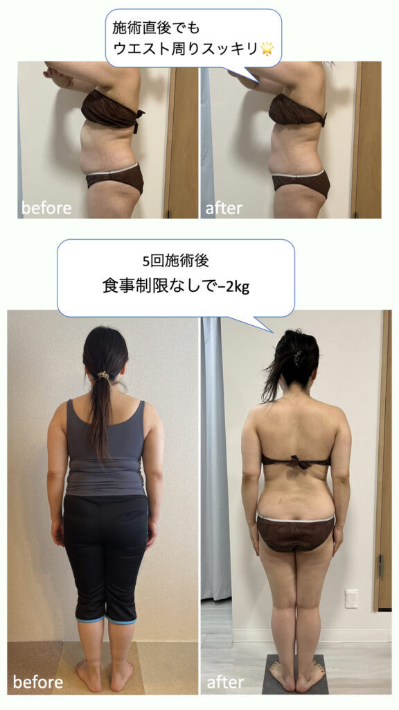 施術直後でもウエスト周りスッキリ！
5回施術後、食事制限なしで−2kg