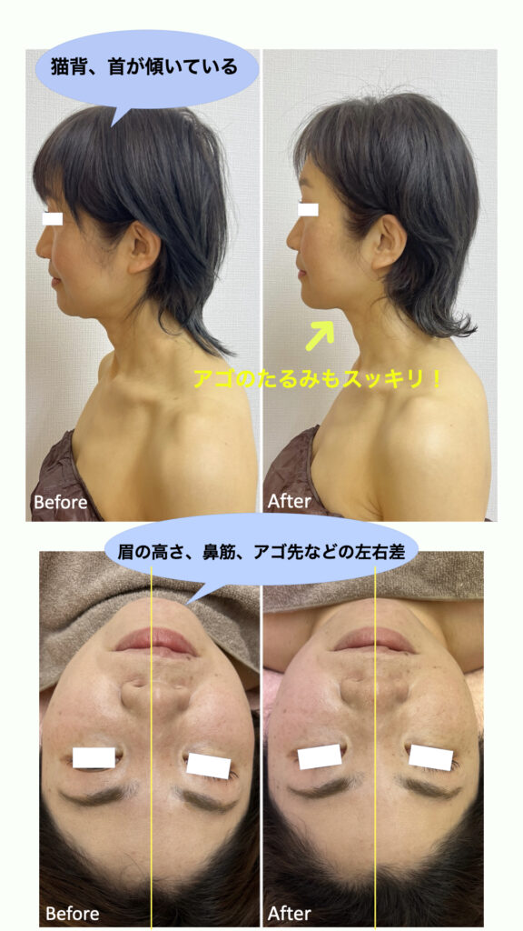 Before：猫背、首が傾いている
After：アゴのたるみもスッキリ

Before：眉の高さ、鼻筋、アゴ先などの左右差
After：ピッタリ整う